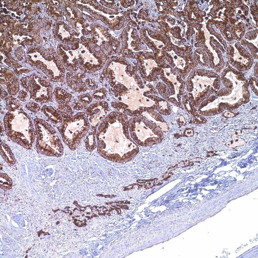 Napsin A Clone: Polyclonal Visualization: Cytoplasmic Lung adenocarcinoma Multiple