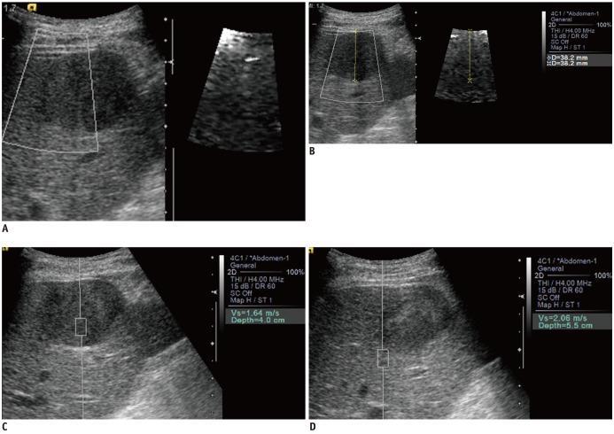 US elastography The stiffness of a lesion can be