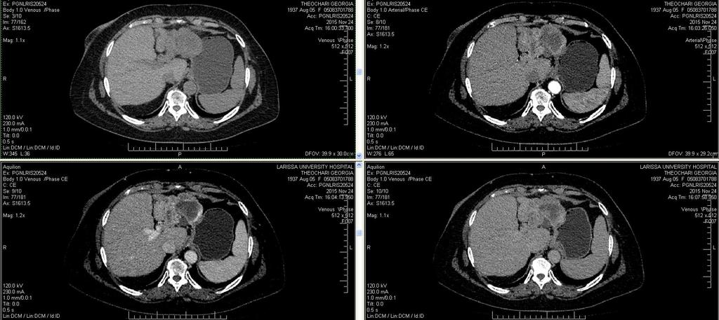 Dynamic CT follow up Recurrence of a previously treated HCC by