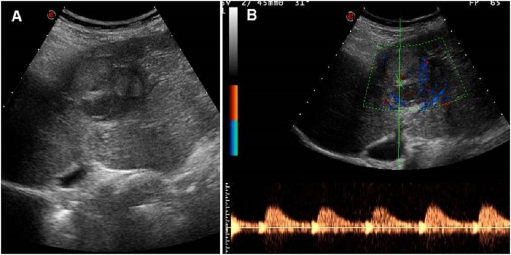 Ultrasound Gray scale and color Doppler ultrasound Contrast enhanced Ultrasound Intraoperative US