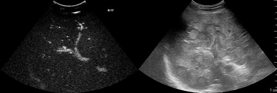 Contrast enhanced Ultrasound Heterogeneous hyperenhancement of intra-hepatic