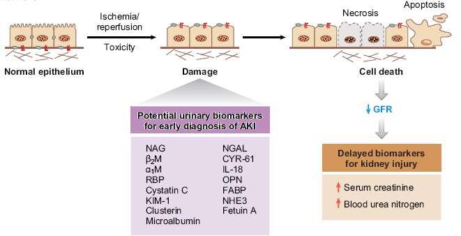 Ischemic renal AKI and Biomarker monitor tubular injury in AKI New AKI biomarkers NGAL,