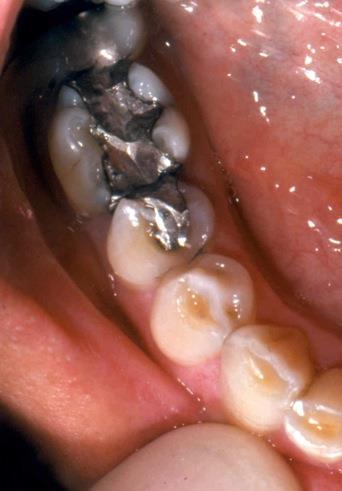 48 Amalgam Safety Amalgam, the silver colored restoration material used to fill cavities, has received attention as it contains small amounts of mercury Mercury is bound in a stable matrix and the
