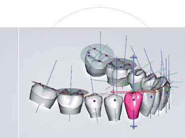 The new Digital Setup allows orthodontists to view the models from any direction, zoom and select separate views of Malocclusion and Setup.