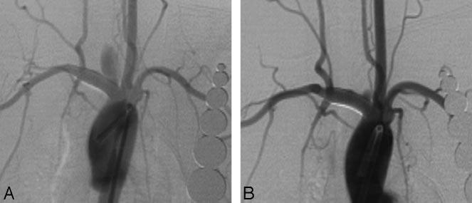 5 Note: PED indicates Pipeline Embolization Device. * Data are represented as the mean SD. There were no significant differences. Fig 1.