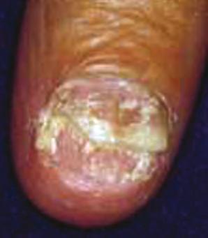 Lesions are small ranging from two to five millimeters in diameter. In the guttate variant, throat cultures should be taken to rule out streptococcal infection.