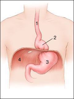 The Esophagus Muscular tube that leads to stomach, lies behind the trachea Hiatal hernia weak diaphragm allows