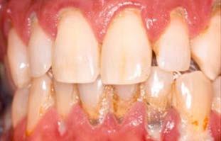 Oral Disease Prevalence Tooth Decay Most common chronic disease in childhood Nearly 40% of