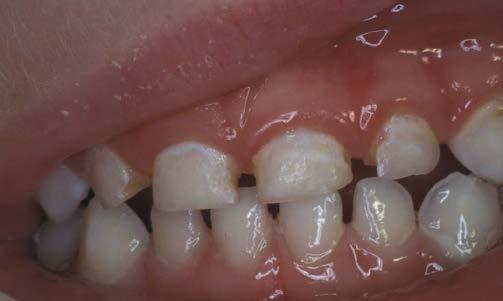 have untreated tooth decay Periodontal Disease 47% of U.S.