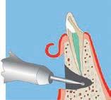 assure a satisfying solution to the root canal access