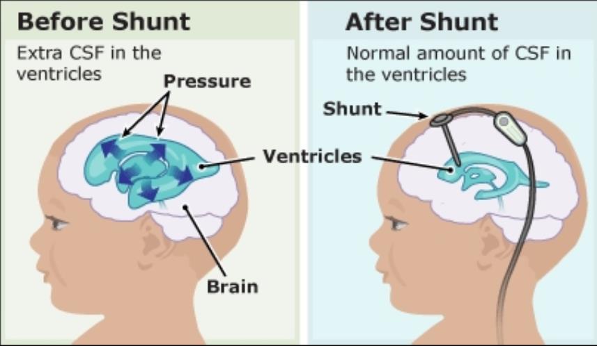 About shunts 1M+ Americans live with hydrocephalus including 1 in 1,000 children born with hydroceplalus.