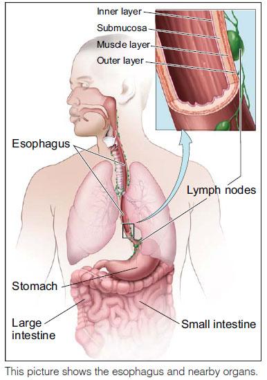 Adenocarcinoma is the most common type of esophageal cancer in the United States. It is often found in the lower part of the esophagus, near the stomach.