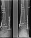 Tibial plafond (pilon) fractures are complex peri-articular injuries commonly associated with multiple metaphyseal fragments, bone loss, comminution and severe soft tissue injury.