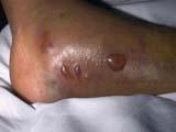 Abrasions Fracture blisters