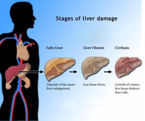 Liver Damaging Factors In a subset of individuals hepatic steatosis promotes an inflammatory response in the