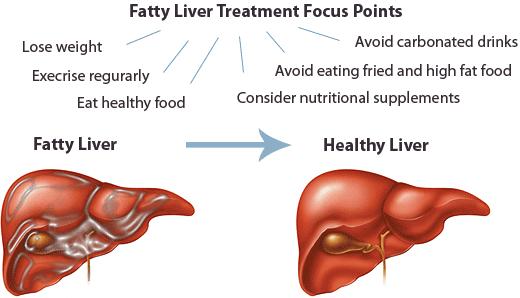 Fatty liver Nonalcoholic fatty liver disease (NAFLD) is the most common form of liver disease in Western countries.