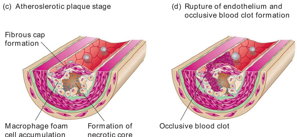 Plaque Stage and Rupture of Endothelium With Blood Clot Formation