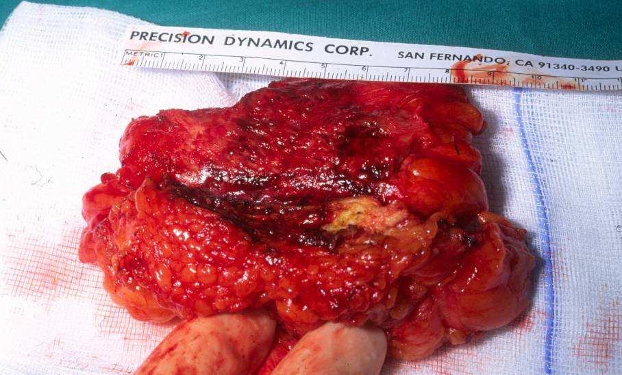 Surgical techniques Pleurectomy / decortication removal involved parietal + visceral