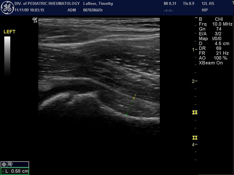 34 Pathology - Definition Synovitis Omeract Synovitis on ultrasonography in children B-mode and Doppler Depending on the joint, synovitis can be