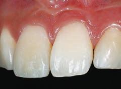 ONE COAT BOND forms an adhesive bridge between tooth structure and composite.