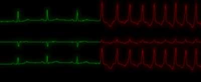 Beyond EKG In the majority of cases the screening of the athletes with EKG and conventional echocardiography allows the correct definition of athlete s heart and differential diagnosis with