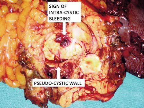 5-7) A medial to lateral spleno-pancreatectomy en bloc with resection of the splenic flexure of the colon was performed.