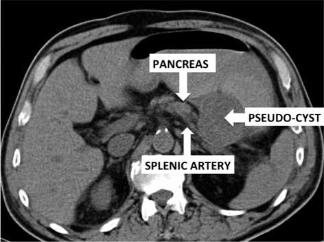 Spleno-Pancreatectomy for Complicated Splenic Artery Pseudo-Aneurysm Case report 2 59 year-old obese male, alcoholic, with a known history of myocardial infarction in 2007, with aorto-coronary