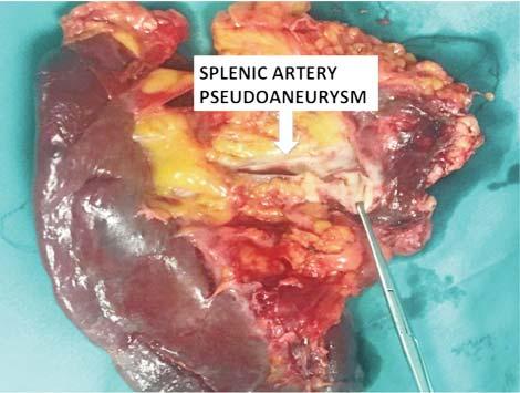 11) The operative surgeon decided to perform a medial to lateral spleno-pancreatectomy en bloc with partial gastric resection. The splenic artery was identified at the superior edge of the pancreas.