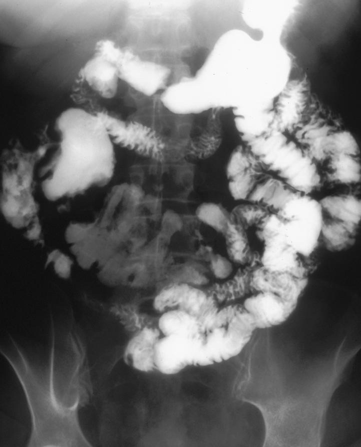 Small Bowel Crohn s Disease: How Many Strictures?