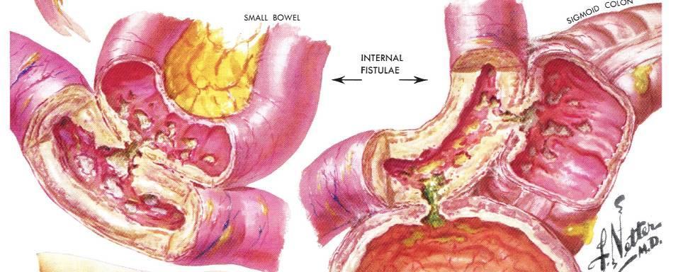 Crohn s Disease: 1960 s Historical Perspective Limited treatment: Sulfasalazine,