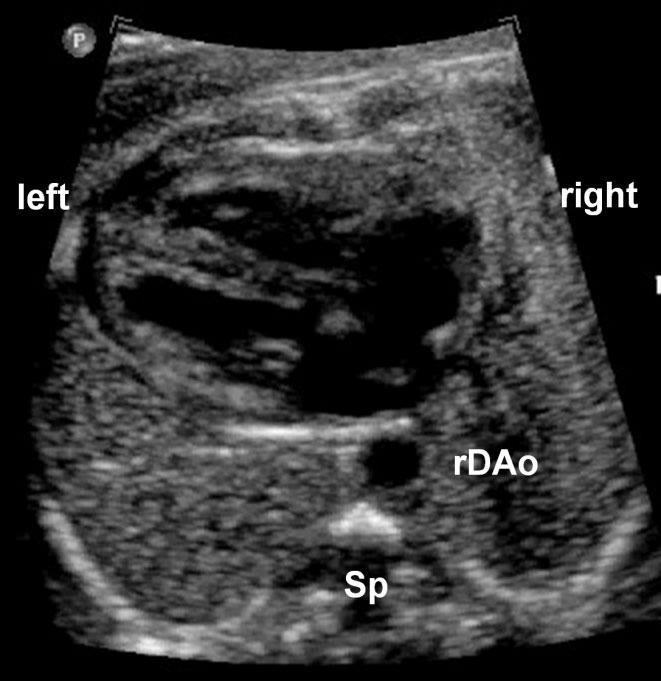 724 Berg et al. malformations. Three fetuses with left isomerism had normal cardiac anatomy.