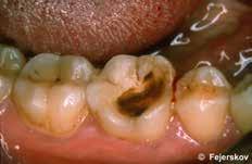 As we hve lredy seen, the infected dentine is of no clinicl consequence s fr s rresting the lesion is concerned nd thus complete excvtion seems creless to the point of eing unethicl.