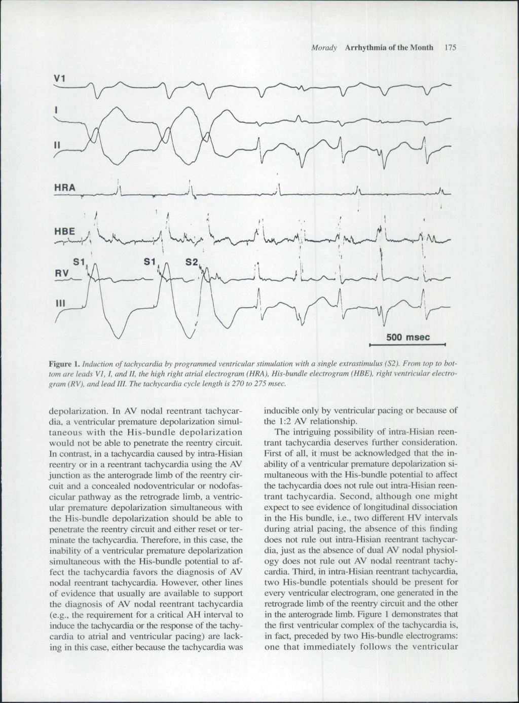 Morady Arrhythmia of the Month 175 HRA HBE Figure 1. Induction of tachycardia by programmed ventricular stimulation with a single extrastimulus (S2). From top to bottom are leads VI, I. and II.