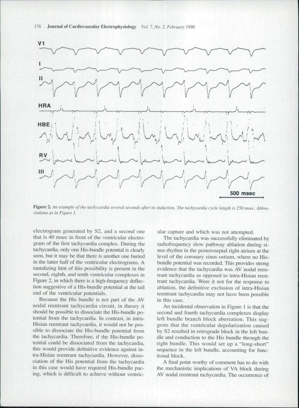 176 Journal of Cardiovascular Electrophysiology Vol. 7. No. 2, Februaiy 1996 500 msec Figure 2. AJ? example of the tachycardia several seconds after its induction.