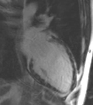 Cardiac MRI with gadolinium patchy