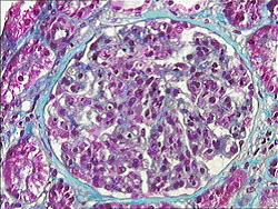 HSP nephritis Focal and segmental proliferative glomerulonephritis 20-61% of HSP patients, depending on criteria for definition of nephritis