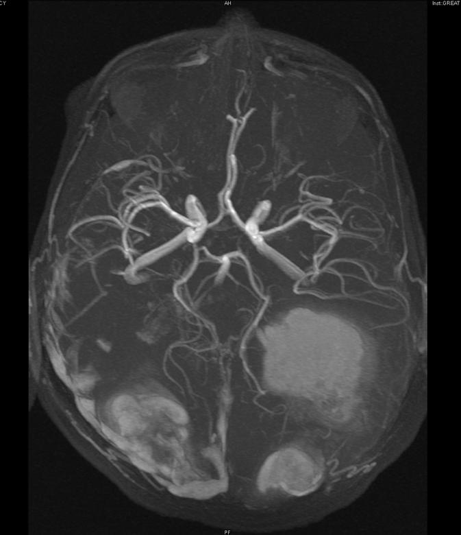 9B: Magnetic resonance angiography (MRA) of the brain performed following acute visual loss in a 12 year old previously well female, with MPO ANCA positivity, but normal renal function.