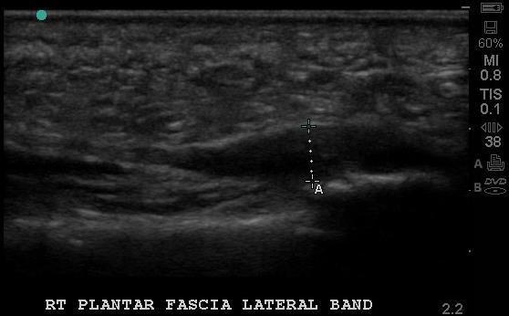 Lateral Band
