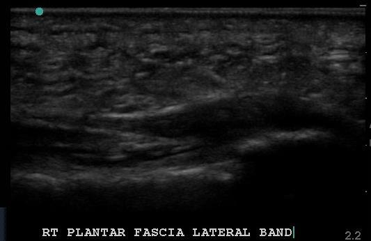 Lateral Band