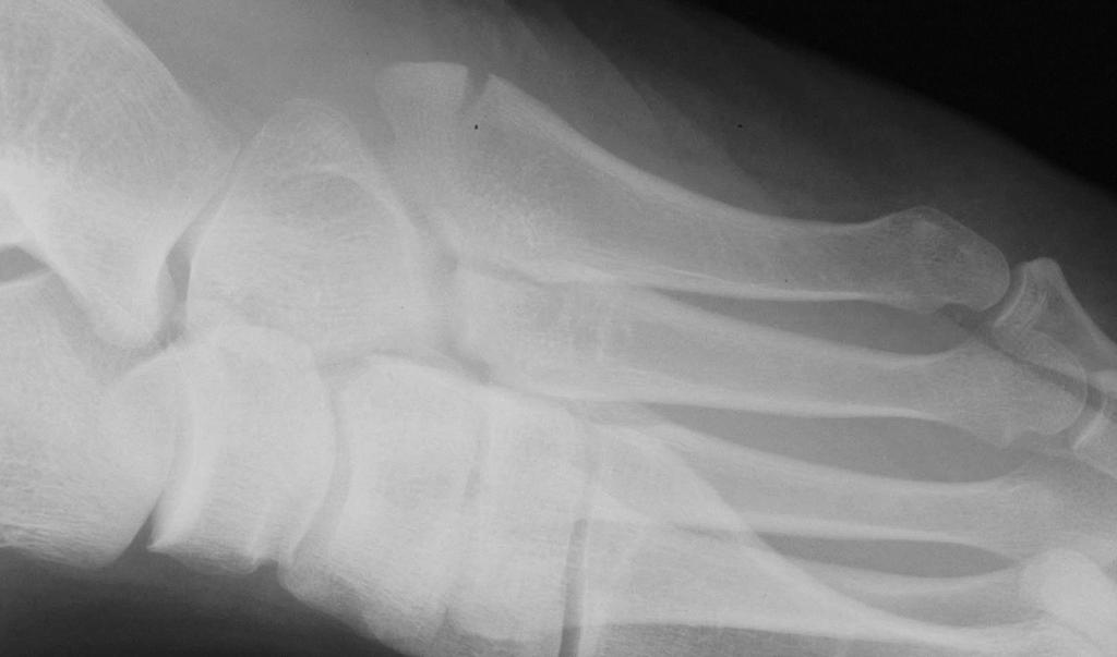 Avulsion Fracture at