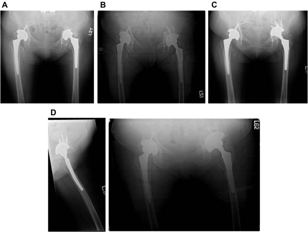 86 Y.-W. Cheng et al. / Formosan Journal of Musculoskeletal Disorders 3 (2012) 83e87 Table 10 Implant survival in advanced acetabular defect (Paprosky 3A, 3B).