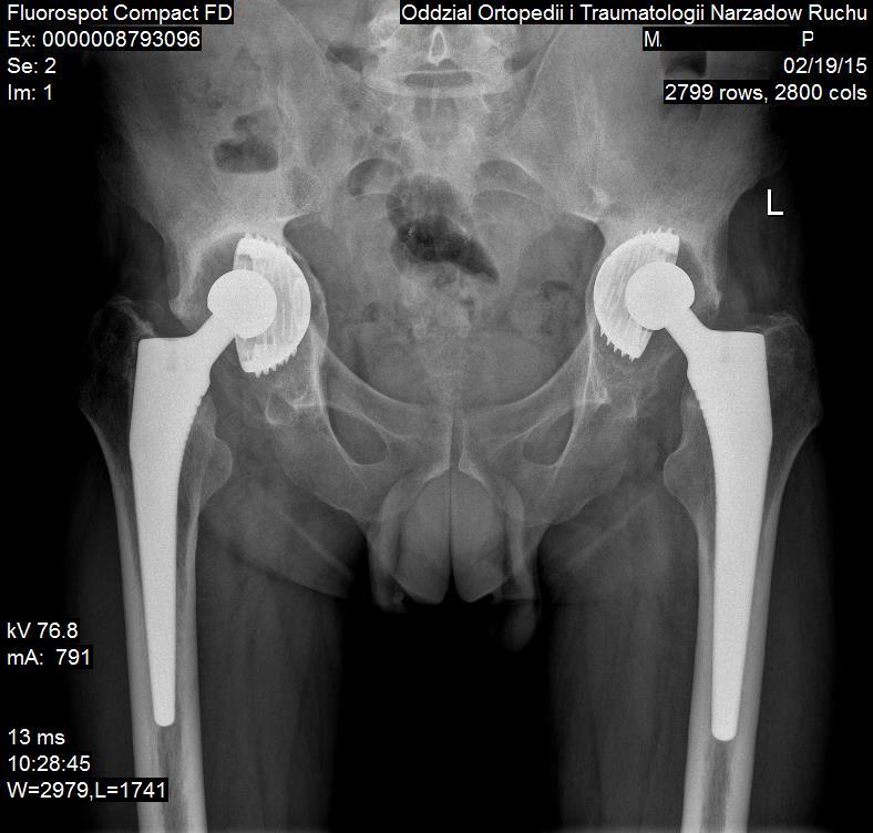 acetabulum: > 70% bone graft is not needed, 50-70% support for the roof and the rear