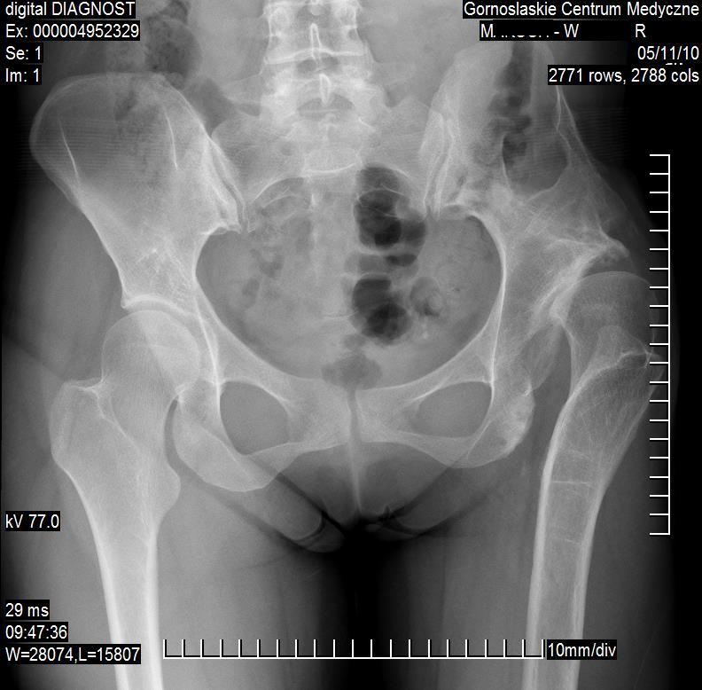 wsp: Cup Press Fit in Uncemented THA Depends on Sex, Acetabular