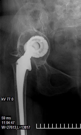 Rewision PSB: screwed acetabulum and stem