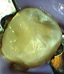 A moist cotton pellet was then placed over the MTA and the rest of the cavity was restored with temporary filling material (Tempit, Centrix Inc, Shelton, CT, USA; Fig. 3).