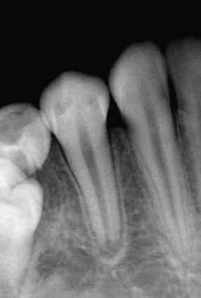 Maturogenesis of immature permanent tooth Fig. 8. Periapical radiograph of contralateral premolar comparing root development at 11 months postoperative.