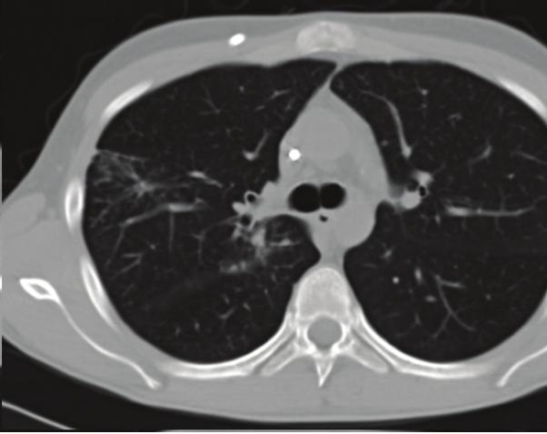 Important milestones are marked with letters: (A) Diagnosis of aspergillosis with extensive lesions in the apical right lung. (B) Improvement of lesions in the apical right lung.