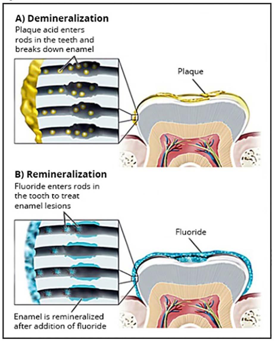 Figure 11. A) Demineralization the caries formation process. Damage occurs in subsurface regions of the enamel, leaving an intact outer layer on the enamel surface.
