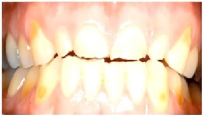 Figure 21. Results from a human in situ clinical lesion progression study comparing a stabilized SnF 2 dentifrice versus a marketed dentifrice formulated with SMFP and arginine bicarbonate.