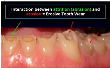 there is so much dentin loss, while the enamel appears to be much less affected.